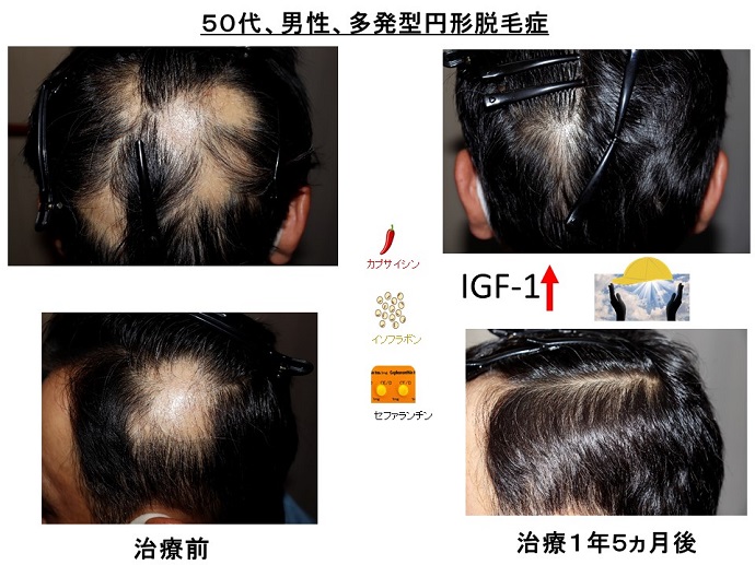 円形脱毛症　病院